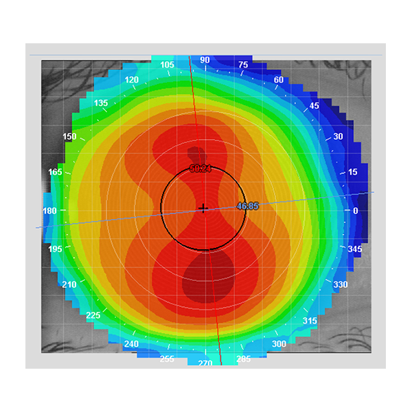 Corneal topography