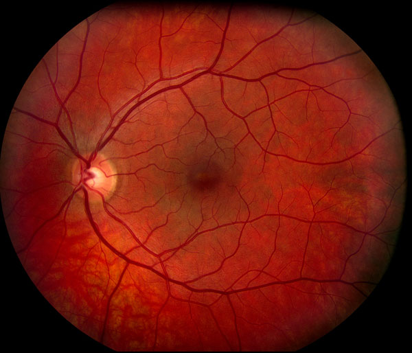 Fundus photograph